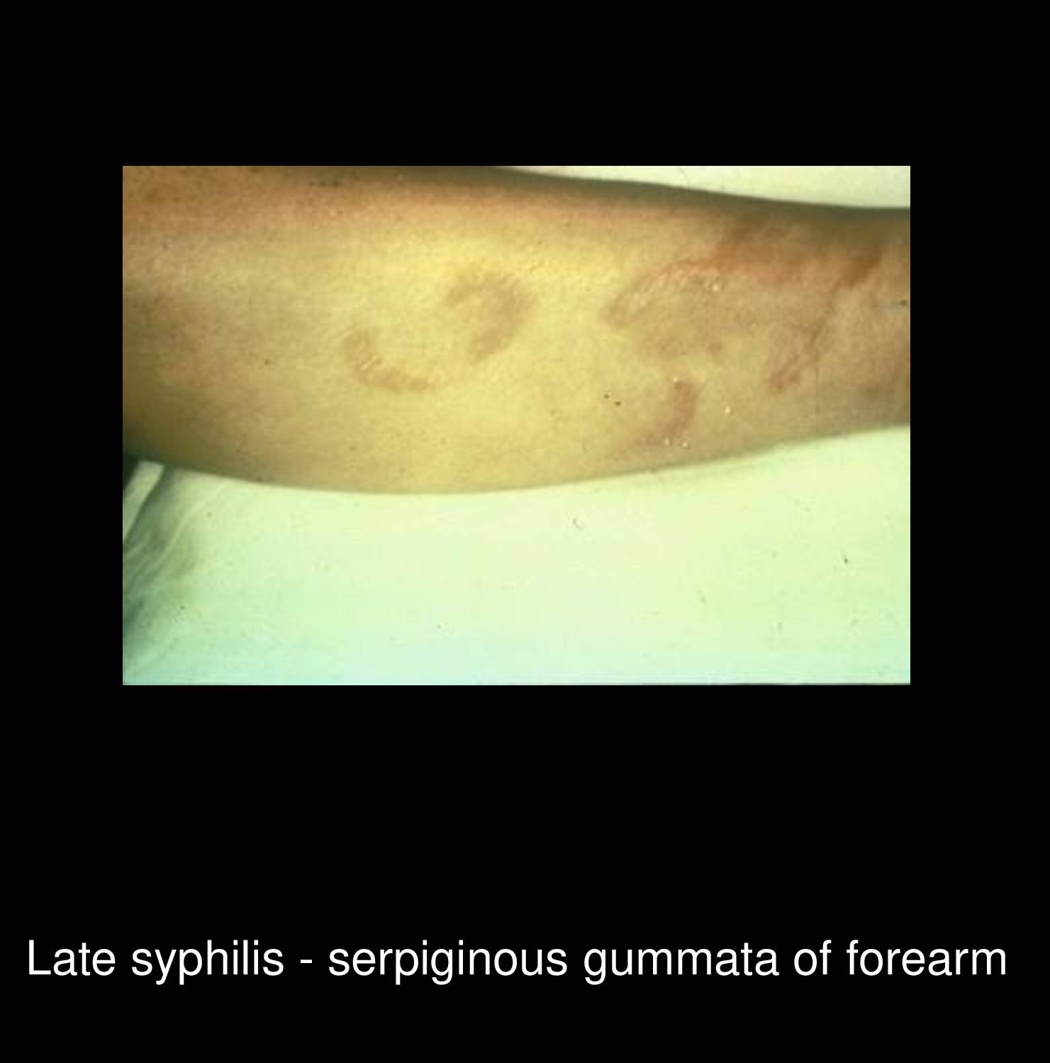 Syphilitic leukoderma on neck showing depigmented macular lesions with hyperpigmented borders in secondary Treponema pallidum infection